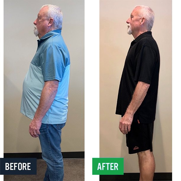 Bill side before and after