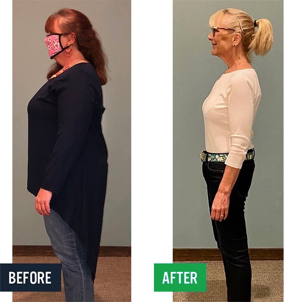 Brenda side before and after