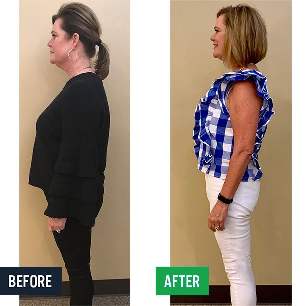 Jennifer side before and after