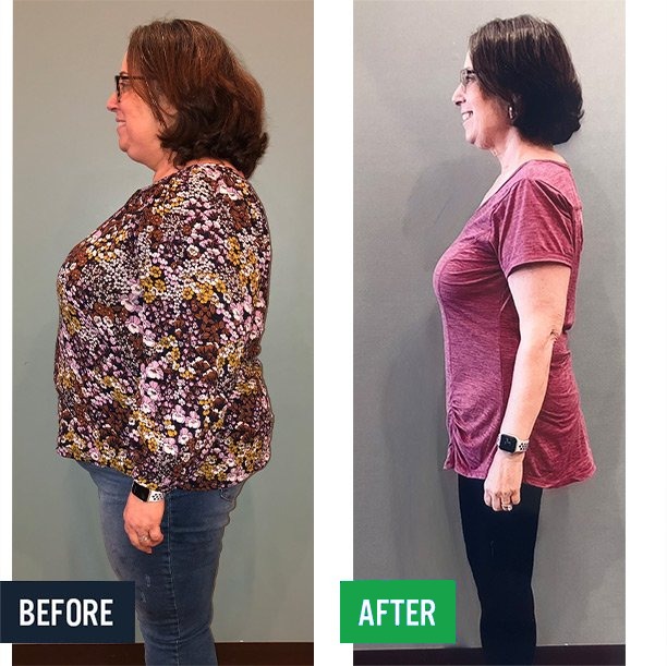 Julie side before and after