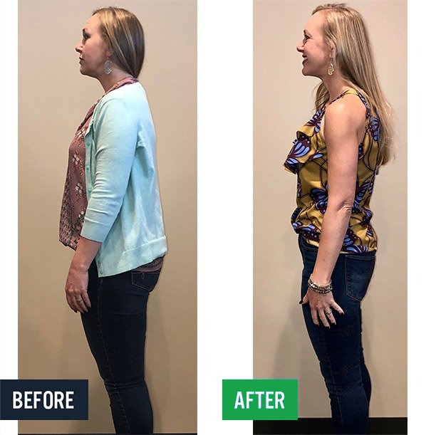 Rachel side before and after